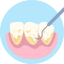 Comment enlever le tartre des dents